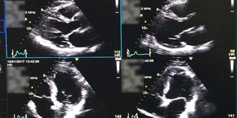 stress echocardiogram results|Overview of stress echocardiography .